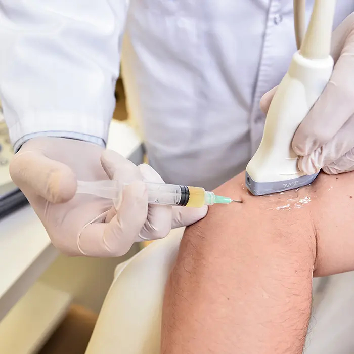 Hyaluronzuur-injectie bij knieartrose (gelspuit)